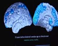 طرح بزرگ پژوهشگران در آمریکا برای پیشگیری از آلزایمر