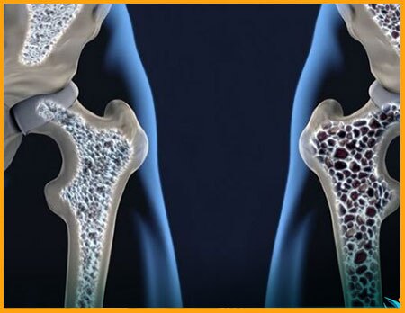 اسکن رایگان پوکی استخوان تا پایان آبان ماه ۱۴۰۴ اسکن رایگان پوکی استخوان تا پایان آبان ماه ۱۴۰۴